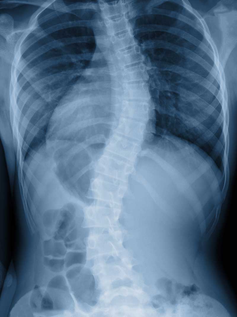 Scoliosis  Columbia, SC 